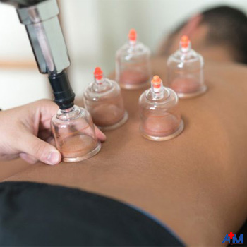 حجامت چه فایده‌ ای برای بدن دارد؟ 